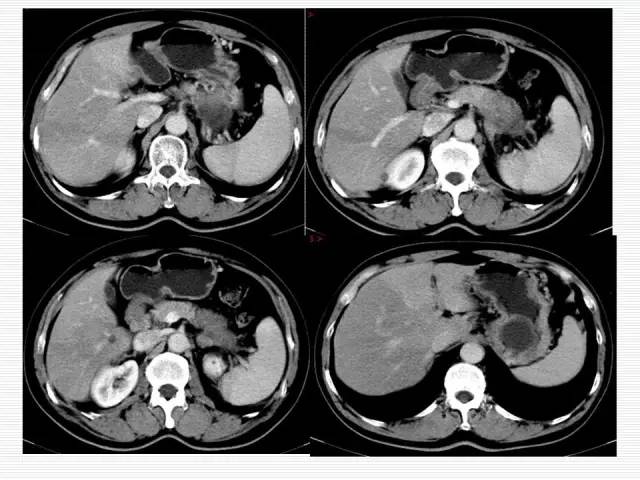 【病例】胰腺囊性病变6例CT影像表现与鉴别 【病例】胰腺囊性病变6例CT影像表现与鉴别