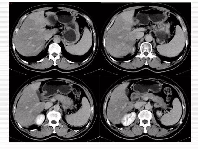 【病例】胰腺囊性病变6例CT影像表现与鉴别 【病例】胰腺囊性病变6例CT影像表现与鉴别