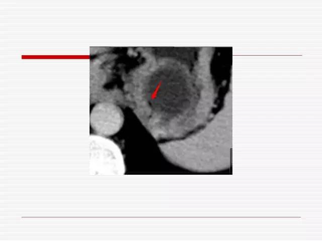 【病例】胰腺囊性病变6例CT影像表现与鉴别 【病例】胰腺囊性病变6例CT影像表现与鉴别