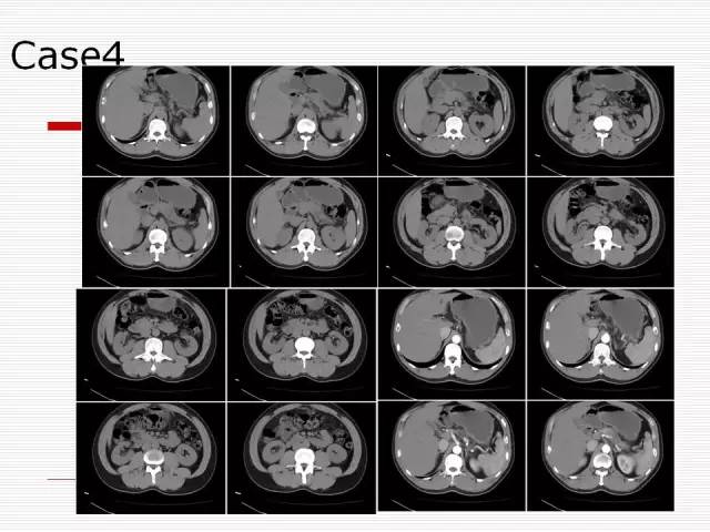 【病例】胰腺囊性病变6例CT影像表现与鉴别 【病例】胰腺囊性病变6例CT影像表现与鉴别
