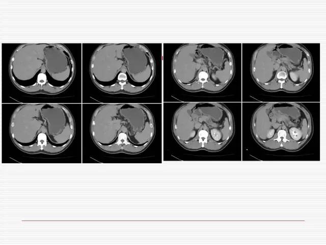 【病例】胰腺囊性病变6例CT影像表现与鉴别 【病例】胰腺囊性病变6例CT影像表现与鉴别