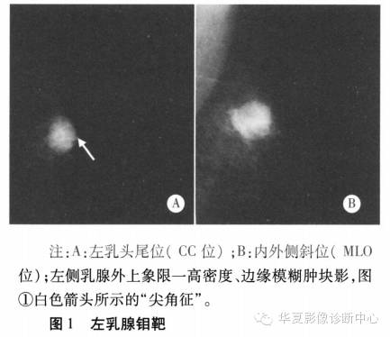 【病例】乳腺炎性肌纤维母细胞瘤影像表现1例