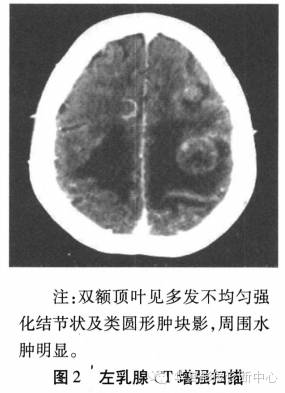 【病例】乳腺炎性肌纤维母细胞瘤影像表现1例 【病例】乳腺炎性肌纤维母细胞瘤影像表现1例