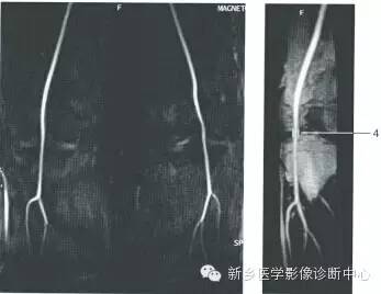 血管和MRCP一些正常影像数值