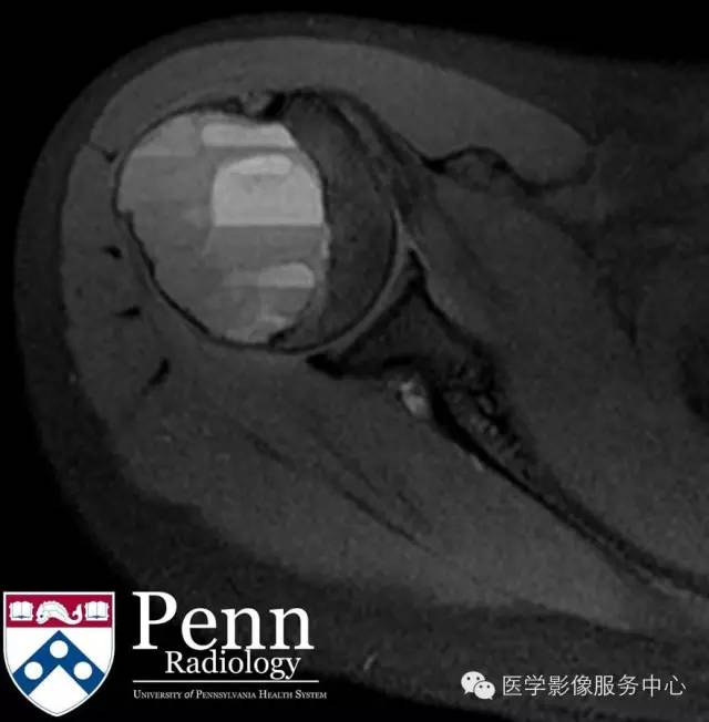 【病例】动脉瘤样骨囊肿1例影像表现 【病例】动脉瘤样骨囊肿1例影像表现