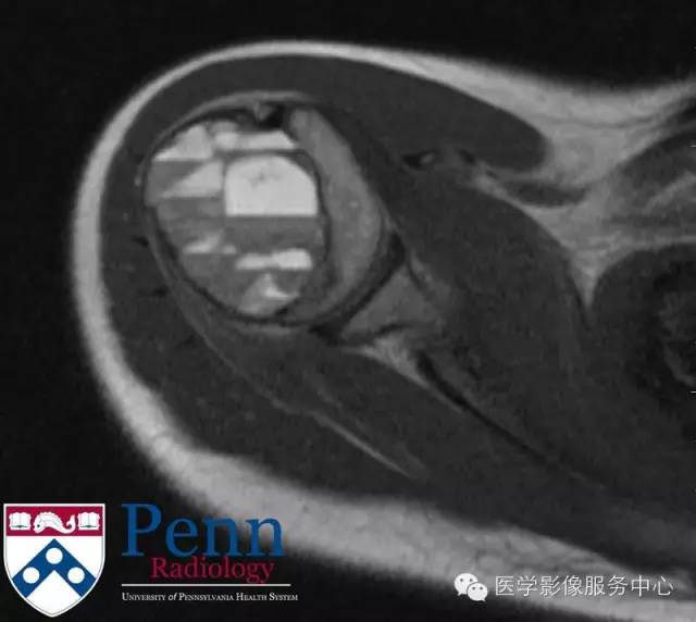 【病例】动脉瘤样骨囊肿1例影像表现 【病例】动脉瘤样骨囊肿1例影像表现