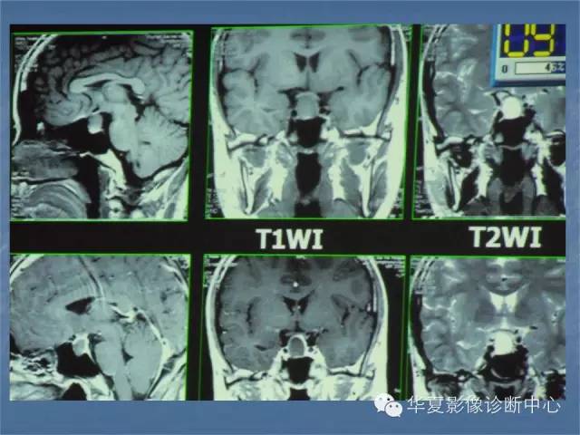 【PPT】鞍区肿瘤的影像诊断