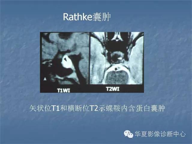 【PPT】鞍区肿瘤的影像诊断