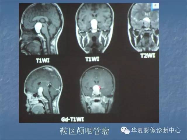 【PPT】鞍区肿瘤的影像诊断