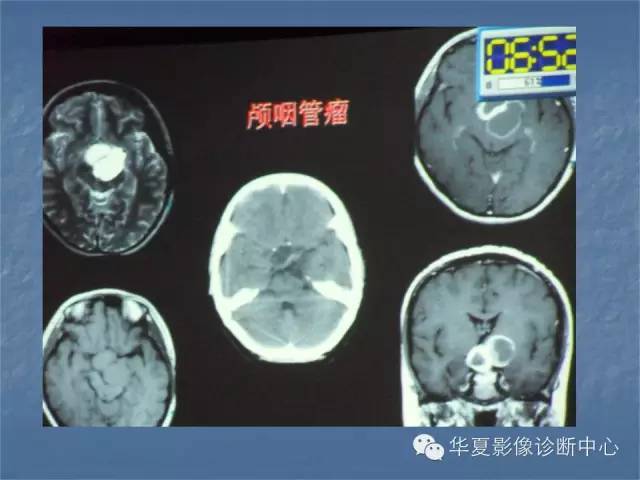 【PPT】鞍区肿瘤的影像诊断