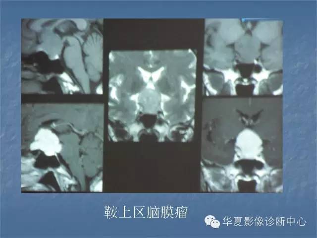 【PPT】鞍区肿瘤的影像诊断