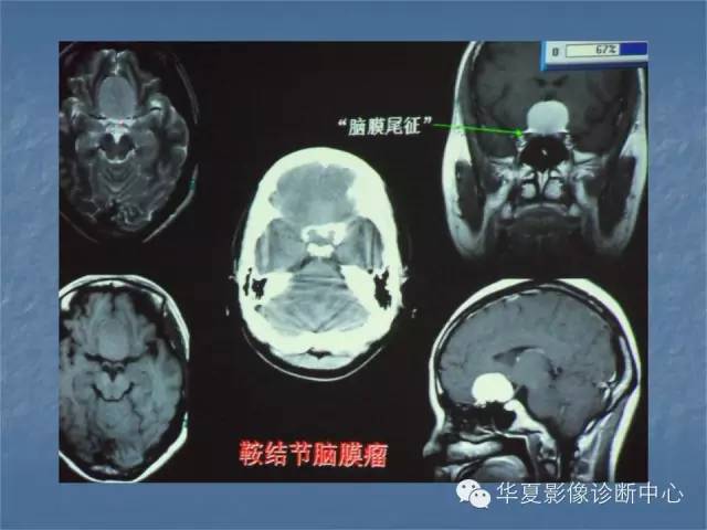 【PPT】鞍区肿瘤的影像诊断