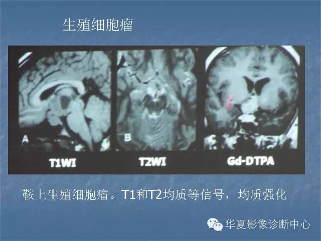 【PPT】鞍区肿瘤的影像诊断