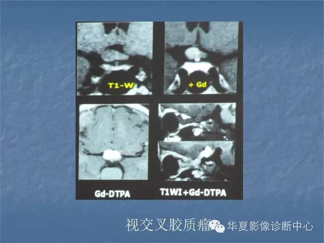 【PPT】鞍区肿瘤的影像诊断