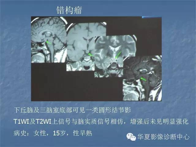 【PPT】鞍区肿瘤的影像诊断