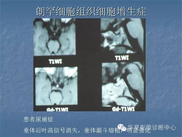 【PPT】鞍区肿瘤的影像诊断