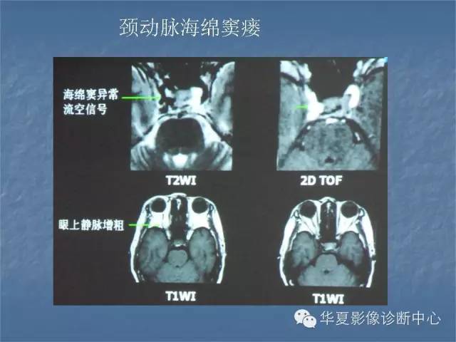 【PPT】鞍区肿瘤的影像诊断
