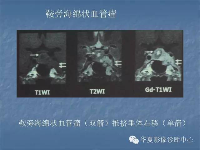 【PPT】鞍区肿瘤的影像诊断