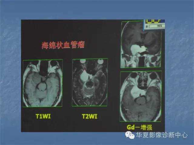 【PPT】鞍区肿瘤的影像诊断