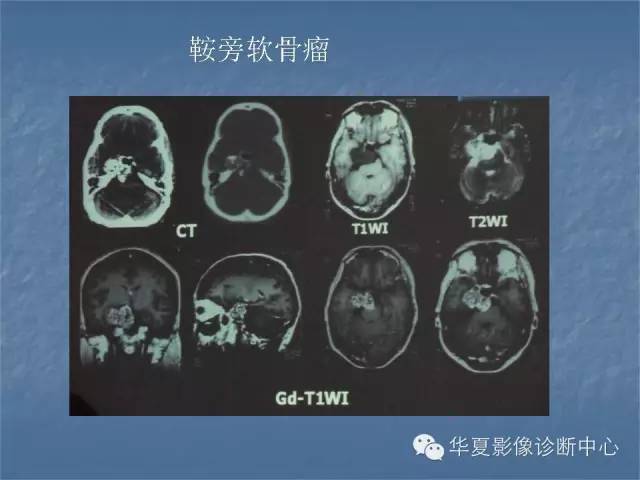 【PPT】鞍区肿瘤的影像诊断