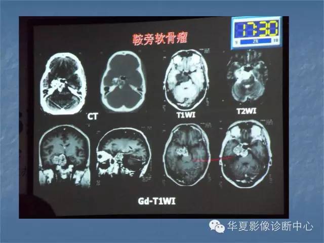 【PPT】鞍区肿瘤的影像诊断