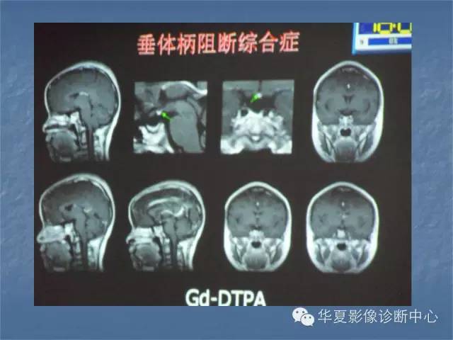 【PPT】鞍区肿瘤的影像诊断