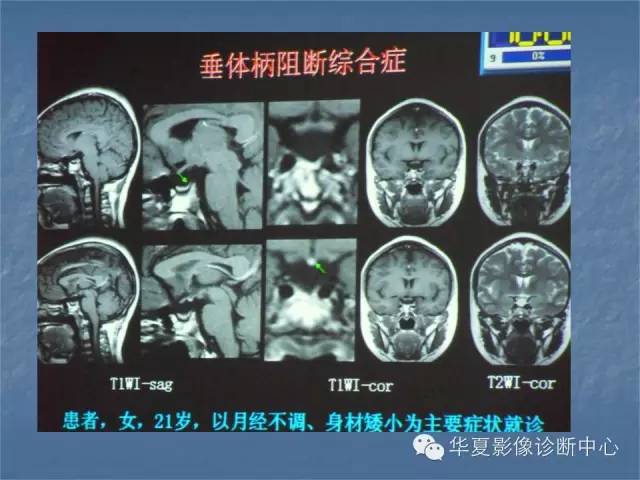【PPT】鞍区肿瘤的影像诊断