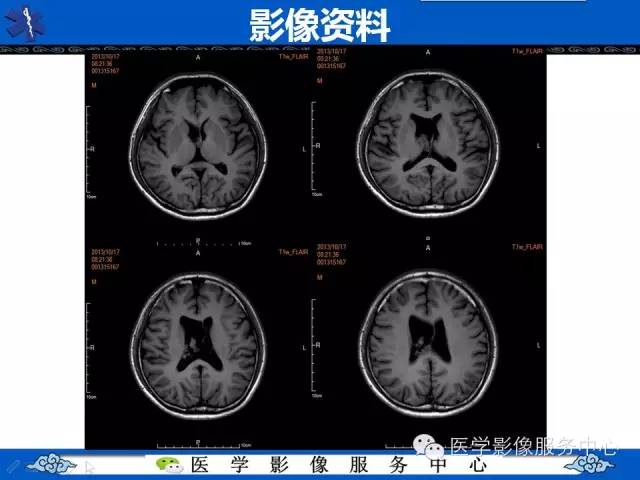 【病例】中枢神经细胞瘤1例MR影像表现