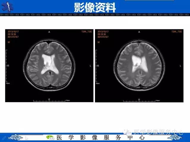 【病例】中枢神经细胞瘤1例MR影像表现