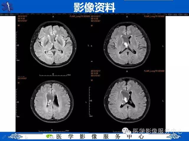 【病例】中枢神经细胞瘤1例MR影像表现