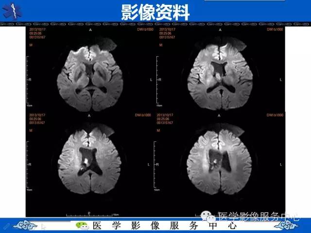 【病例】中枢神经细胞瘤1例MR影像表现