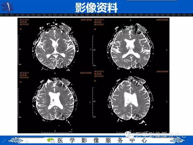 【病例】中枢神经细胞瘤1例MR影像表现