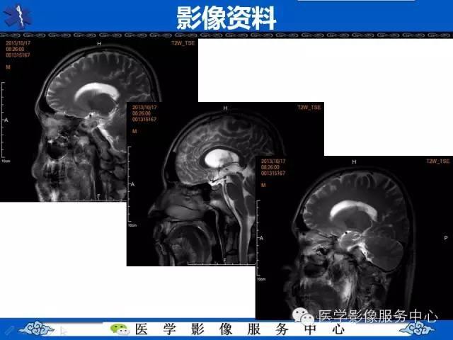 【病例】中枢神经细胞瘤1例MR影像表现