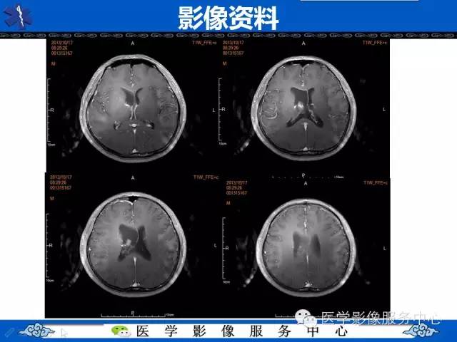 【病例】中枢神经细胞瘤1例MR影像表现