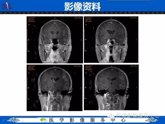 【病例】中枢神经细胞瘤1例MR影像表现