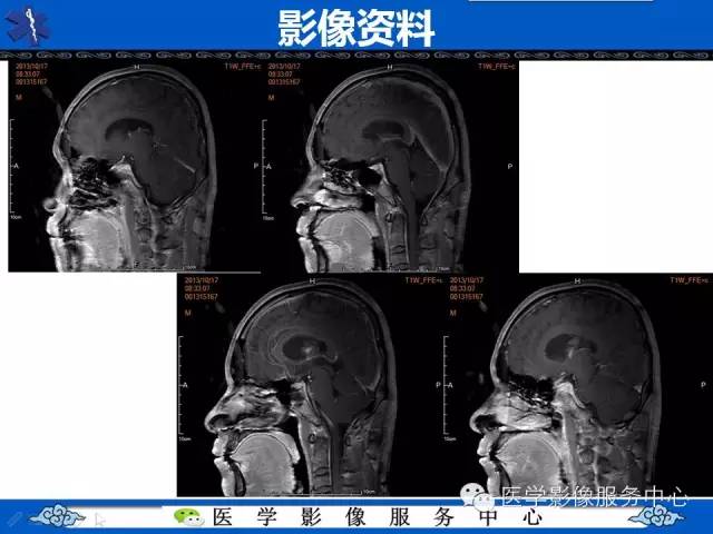 【病例】中枢神经细胞瘤1例MR影像表现