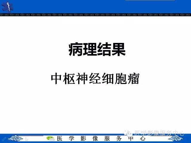 【病例】中枢神经细胞瘤1例MR影像表现
