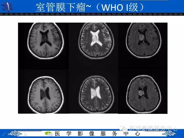 【病例】中枢神经细胞瘤1例MR影像表现
