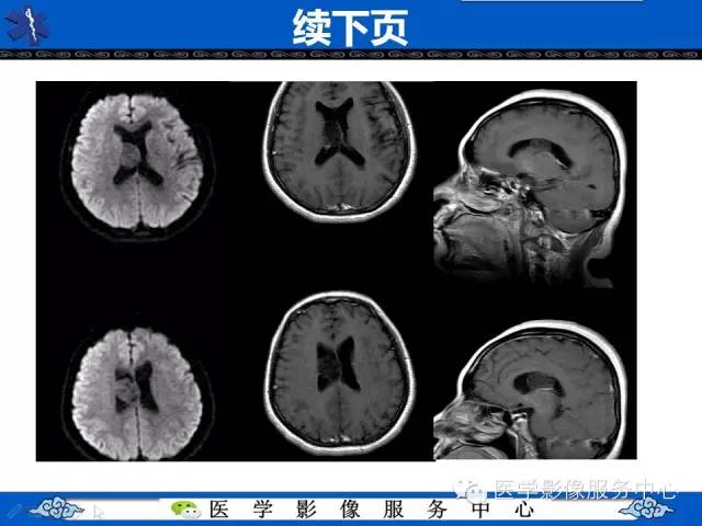 【病例】中枢神经细胞瘤1例MR影像表现