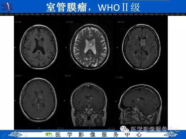 【病例】中枢神经细胞瘤1例MR影像表现