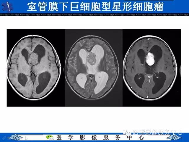 【病例】中枢神经细胞瘤1例MR影像表现