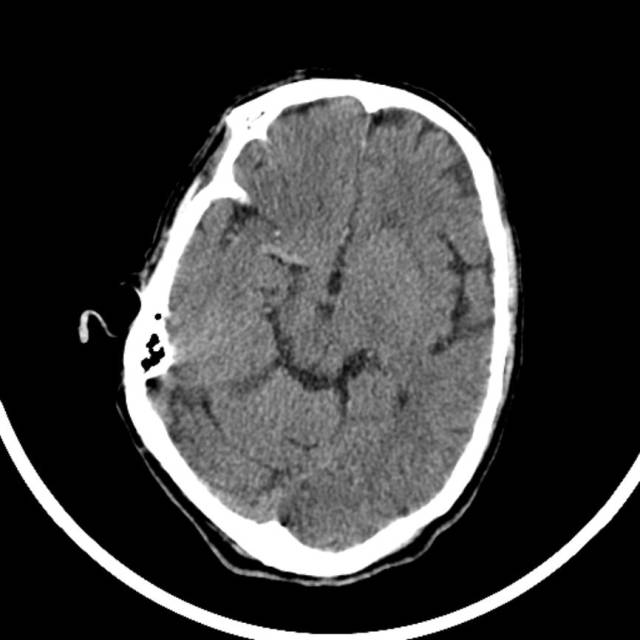 超急性期脑梗死首诊CT表现汇总及典型病例分析 超急性期脑梗死首诊CT表现汇总及典型病例分析