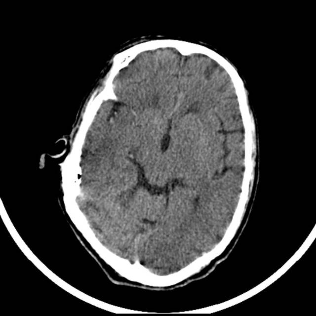 超急性期脑梗死首诊CT表现汇总及典型病例分析 超急性期脑梗死首诊CT表现汇总及典型病例分析