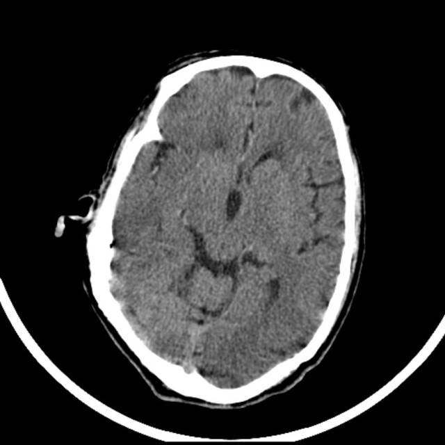 超急性期脑梗死首诊CT表现汇总及典型病例分析 超急性期脑梗死首诊CT表现汇总及典型病例分析