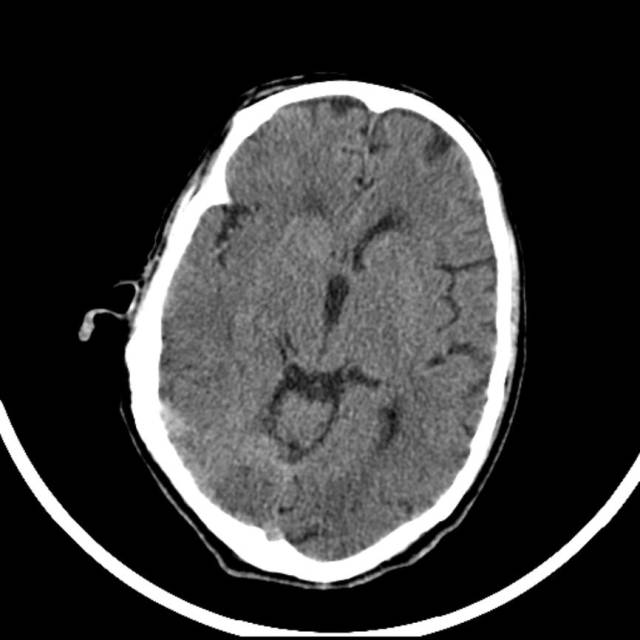 超急性期脑梗死首诊CT表现汇总及典型病例分析 超急性期脑梗死首诊CT表现汇总及典型病例分析