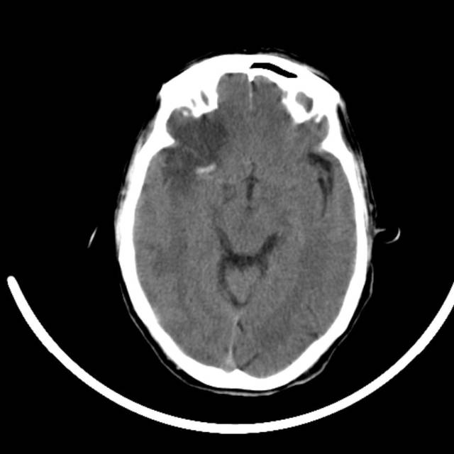 超急性期脑梗死首诊CT表现汇总及典型病例分析 超急性期脑梗死首诊CT表现汇总及典型病例分析