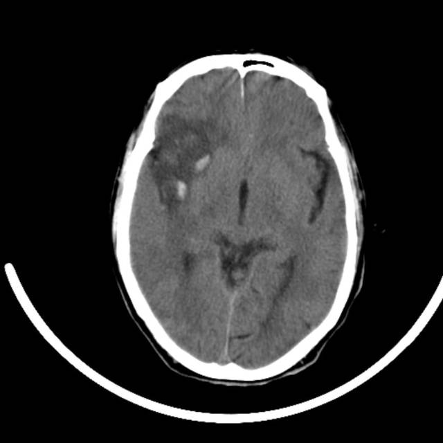 超急性期脑梗死首诊CT表现汇总及典型病例分析 超急性期脑梗死首诊CT表现汇总及典型病例分析