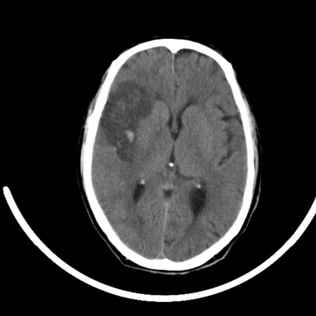 超急性期脑梗死首诊CT表现汇总及典型病例分析 超急性期脑梗死首诊CT表现汇总及典型病例分析