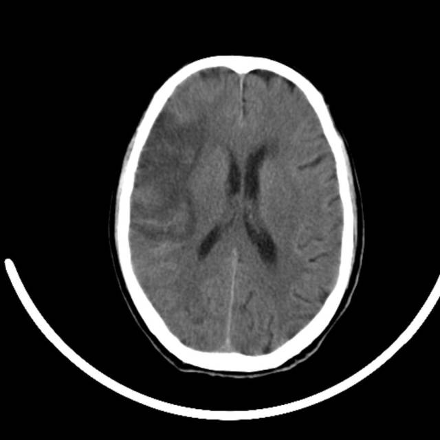 超急性期脑梗死首诊CT表现汇总及典型病例分析 超急性期脑梗死首诊CT表现汇总及典型病例分析