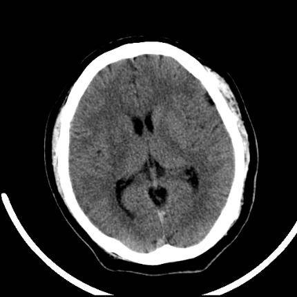 超急性期脑梗死首诊CT表现汇总及典型病例分析 超急性期脑梗死首诊CT表现汇总及典型病例分析